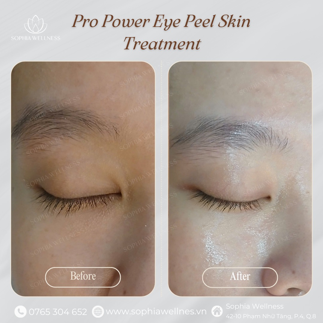 TRẺ HOÁ VÙNG MẮT VỚI PRO POWER EYE PELL