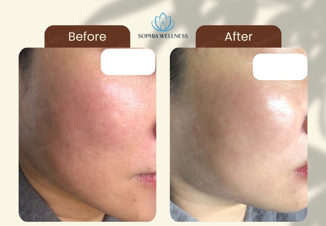 🌿 Dermaplaning – Giải pháp cho làn da mịn màng & sáng khỏe ngay sau 1 buổi!