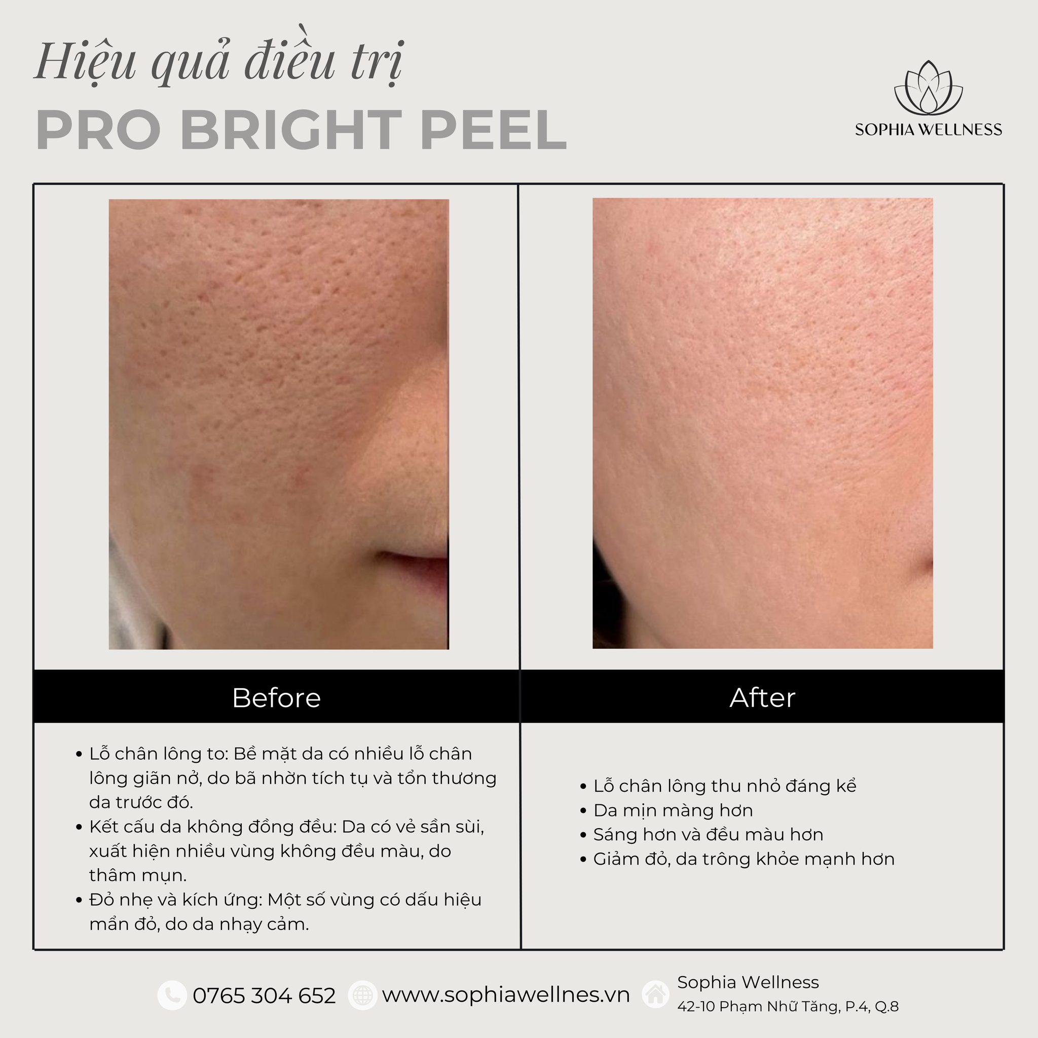 Peel Pro Bright – Da sáng bậc tone, mờ thâm chỉ sau 30 phút!