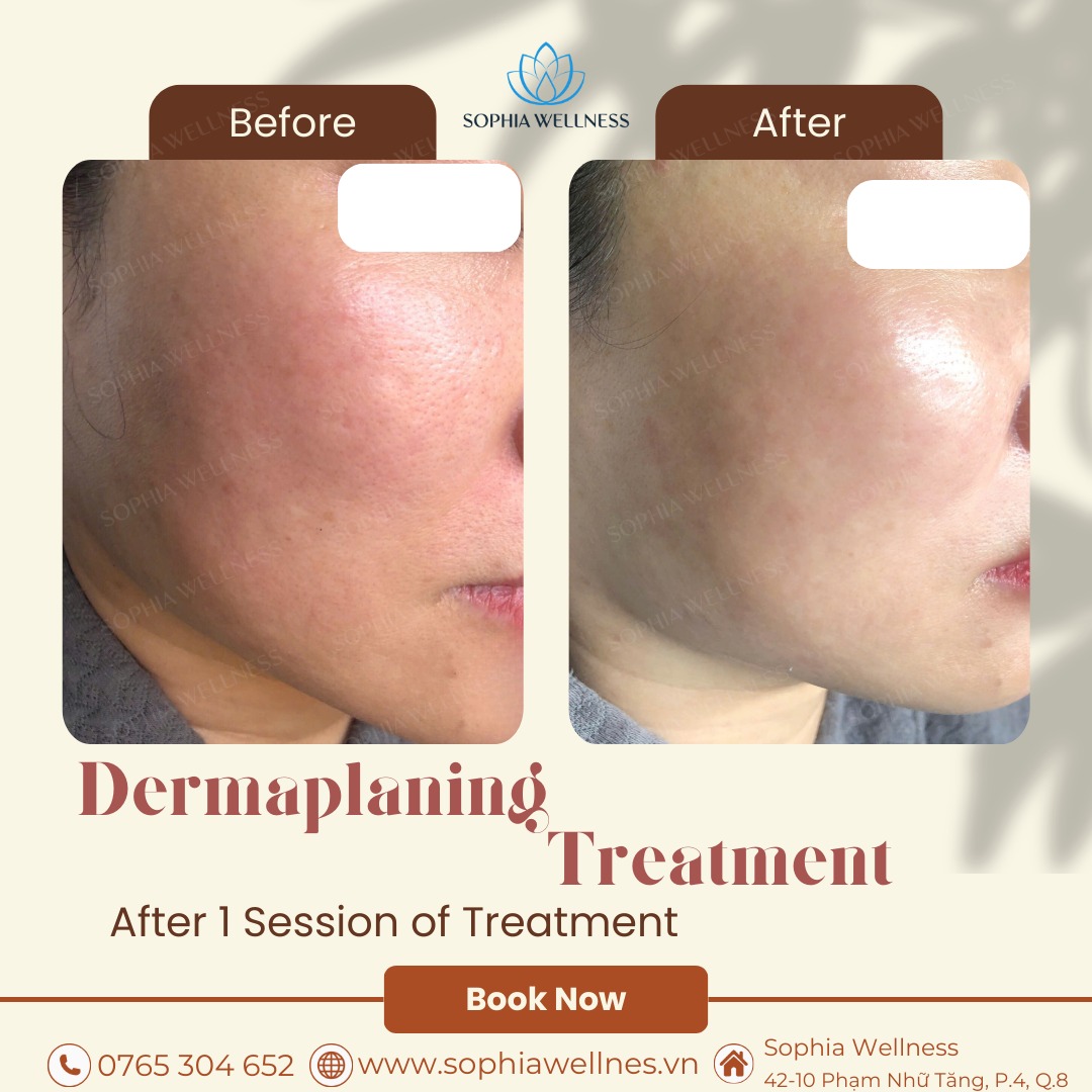 🌿 Dermaplaning – Giải pháp cho làn da mịn màng & sáng khỏe ngay sau 1 buổi!