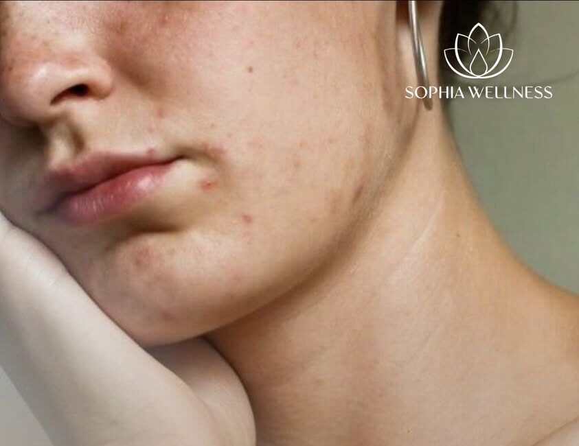 "Da mụn không đáng sợ"! Hiểu Mụn – Hiểu Mình, Chăm Sóc Da Khoa Học Cùng Sophia Wellness