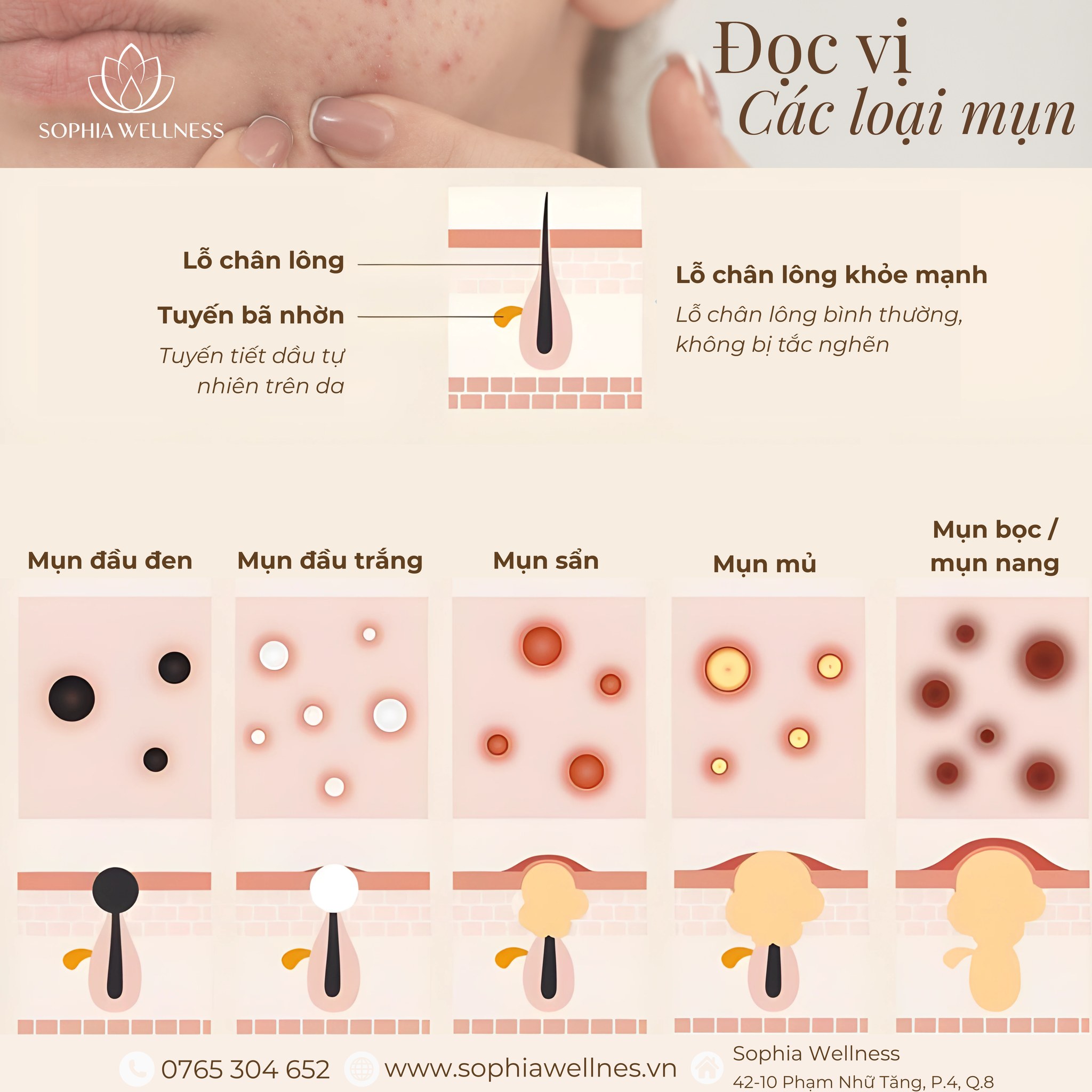 "Da mụn không đáng sợ"! Hiểu Mụn – Hiểu Mình, Chăm Sóc Da Khoa Học Cùng Sophia Wellness