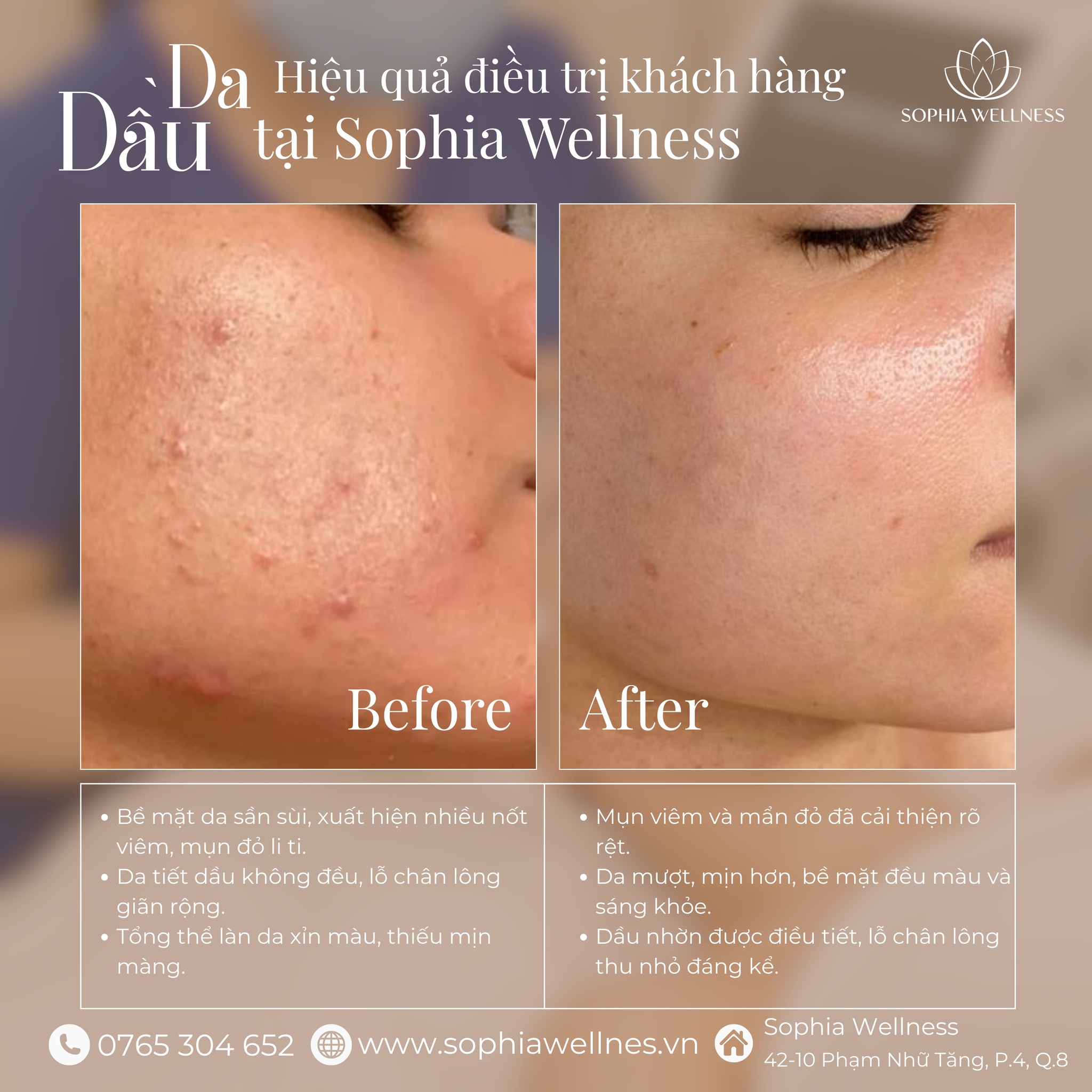 Da Dầu Có Cần Dưỡng Ẩm Không? – Câu Trả Lời Khiến Bạn Bất Ngờ!
