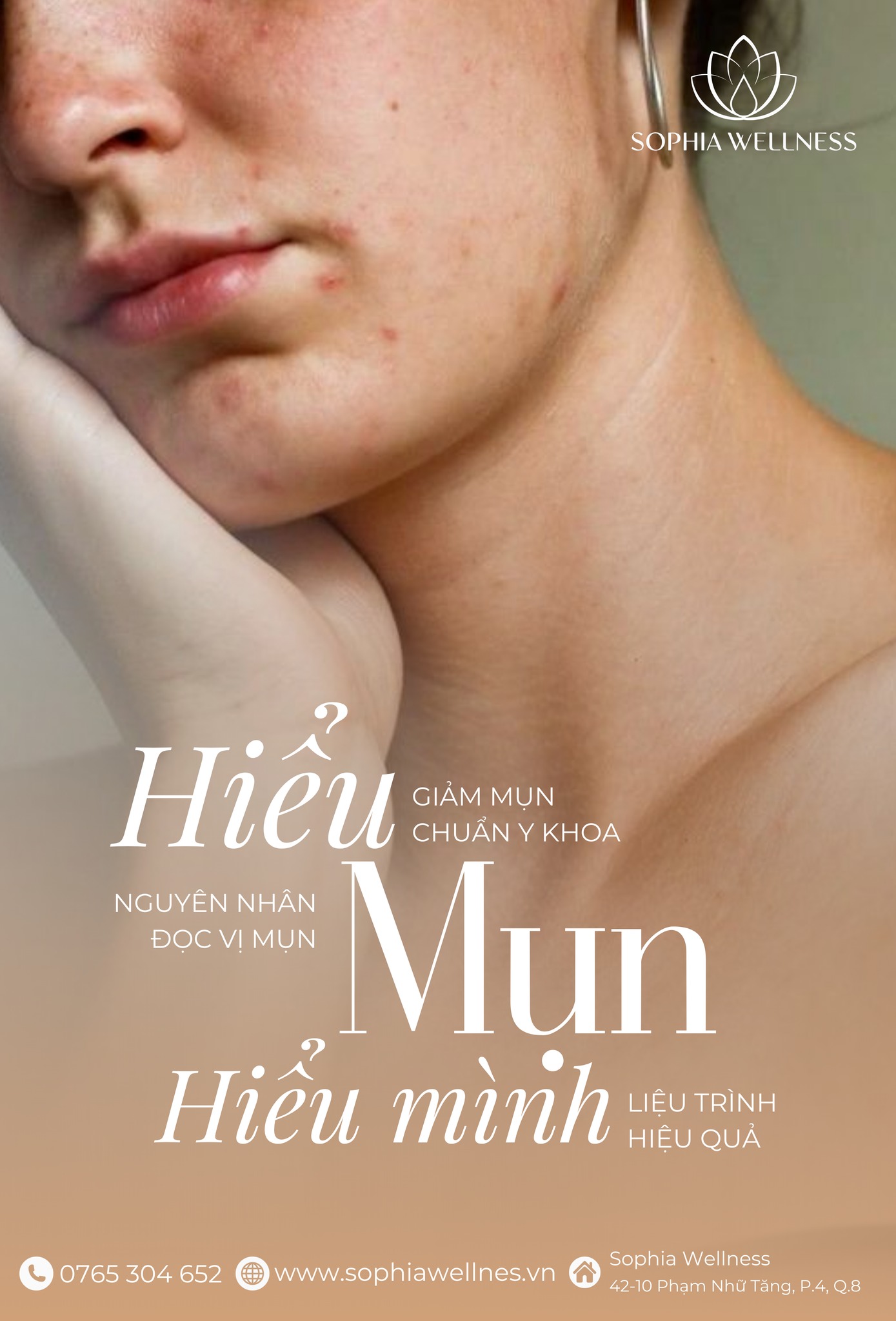 "Da mụn không đáng sợ"! Hiểu Mụn – Hiểu Mình, Chăm Sóc Da Khoa Học Cùng Sophia Wellness