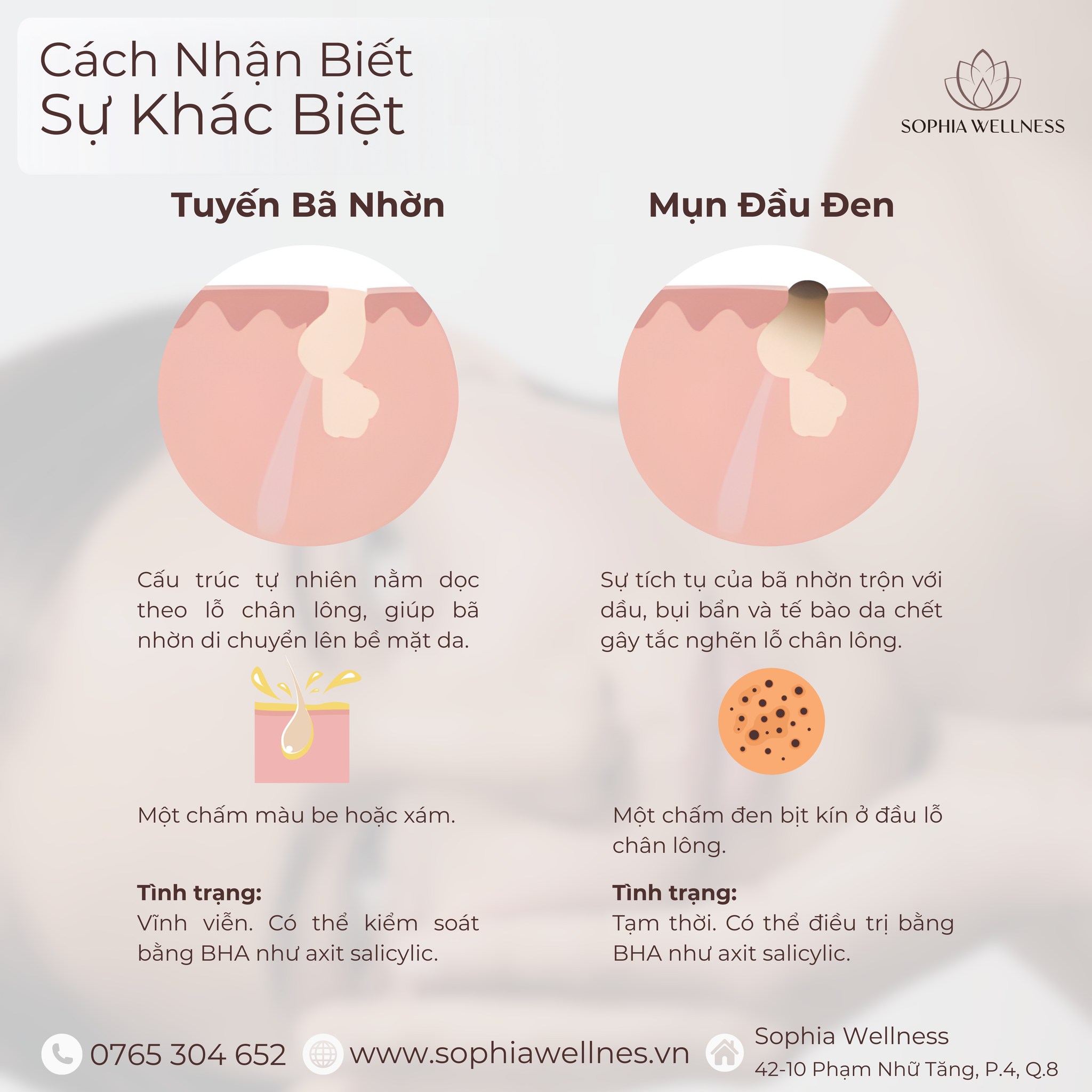 “DỨT ĐIỂM” MỤN ĐẦU ĐEN – KHÔNG ĐỂ LẠI LỖ CHÂN LÔNG