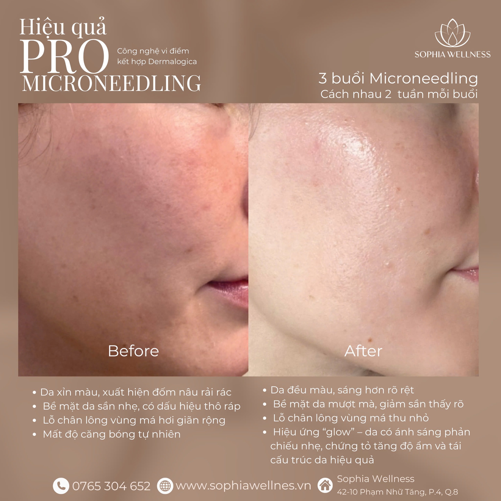 PRO MICRONEEDLING – “THỨC TỈNH” COLLAGEN, ĐÁNH THỨC LÀN DA