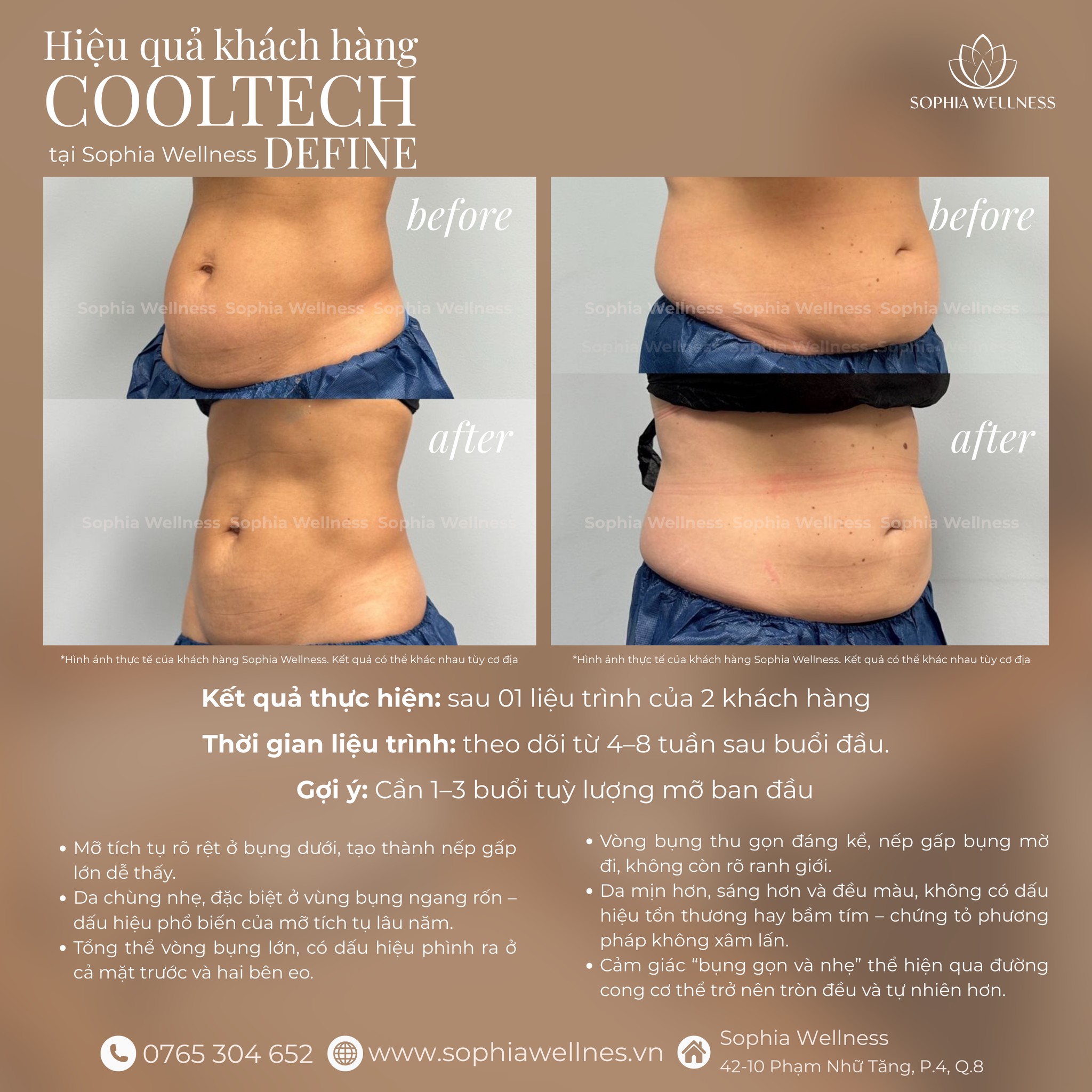 Thon gọn cấp tốc sau 1 buổi với COOLTECH DEFINE – Công nghệ đông huỷ mỡ 360° thế hệ mới