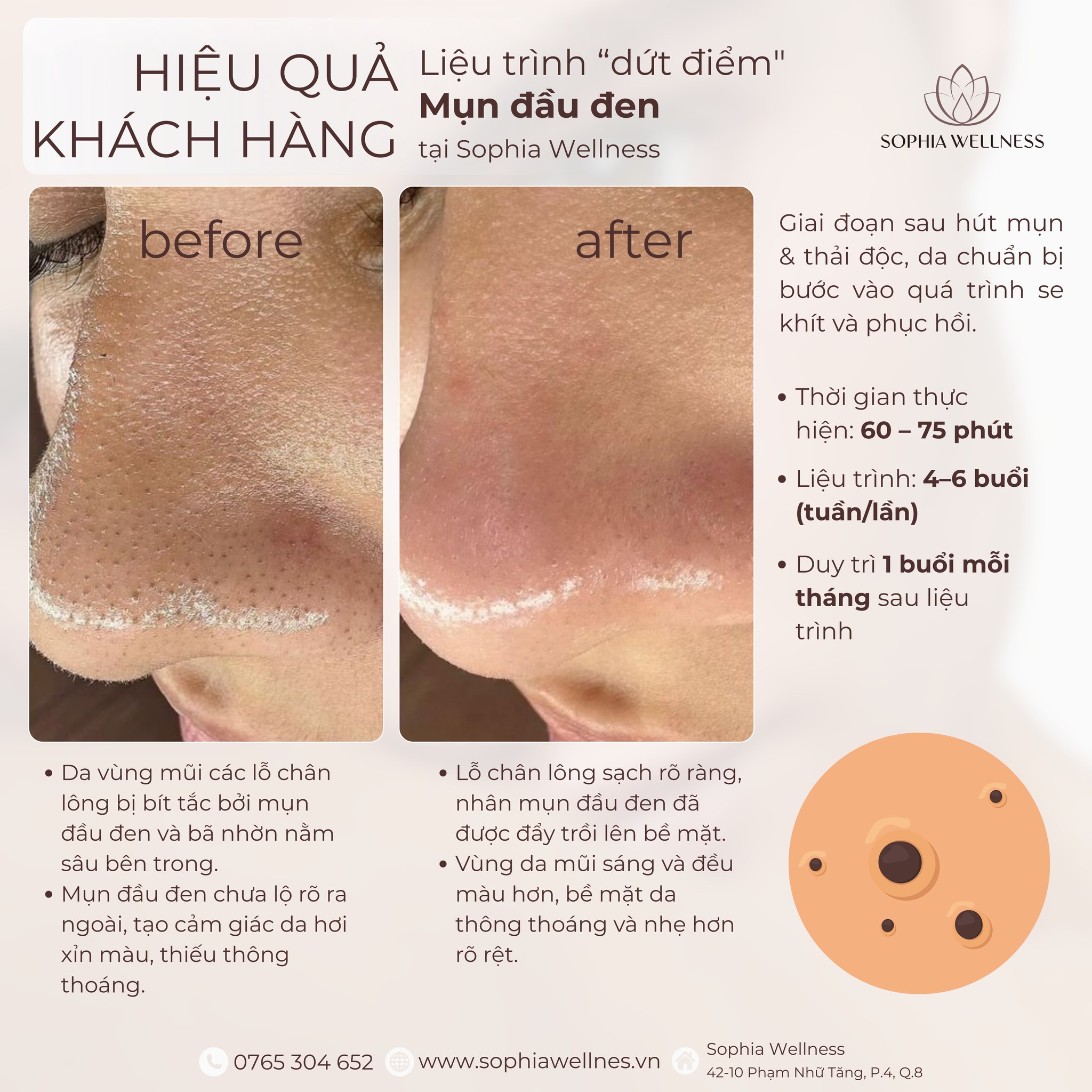 “DỨT ĐIỂM” MỤN ĐẦU ĐEN – KHÔNG ĐỂ LẠI LỖ CHÂN LÔNG