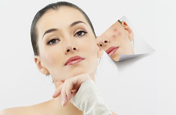 Dưỡng phục hồi sau mụn