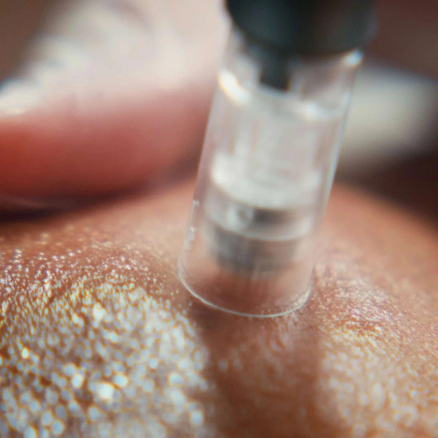 Pro Microneedling - Ảnh 2