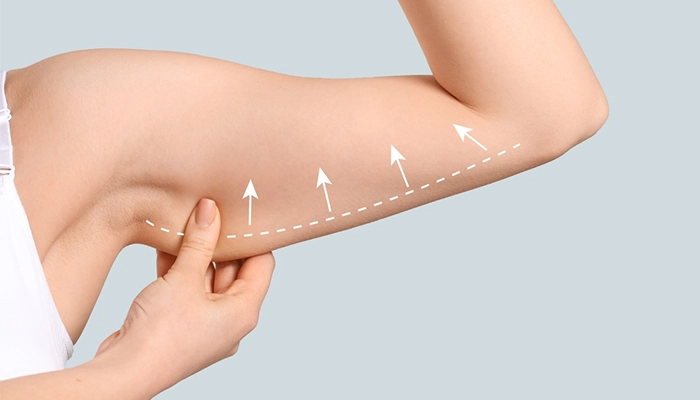 Bắp tay (Underarm Fat) – 180 shot