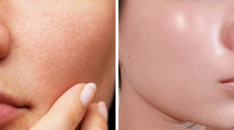 Làm mờ sẹo nhẹ, lỗ chân lông